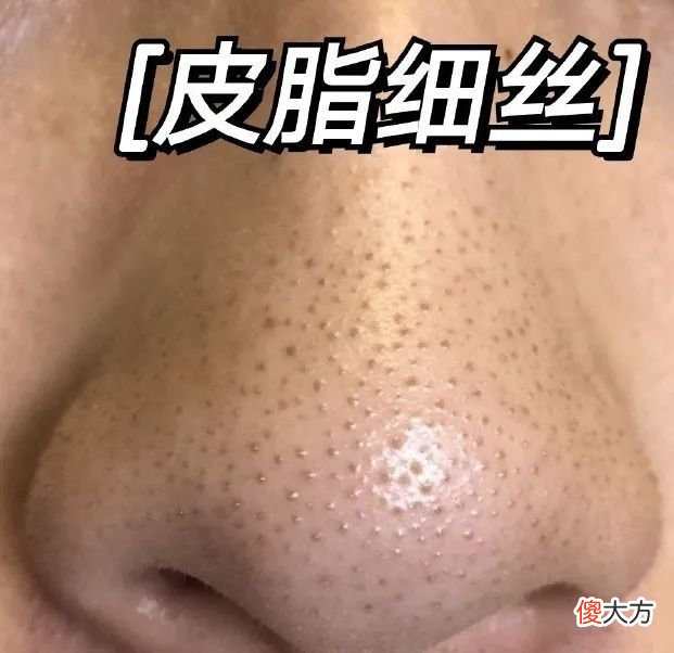 【就爱时尚】黑头、毛孔粗大、鼻翼泛红……鼻子4种皮肤问题这样应对！
