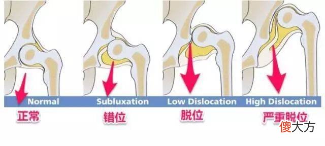 宝宝的臀纹不对称不仅“屁蛋丑”，还有发育隐患，错过难弥补
