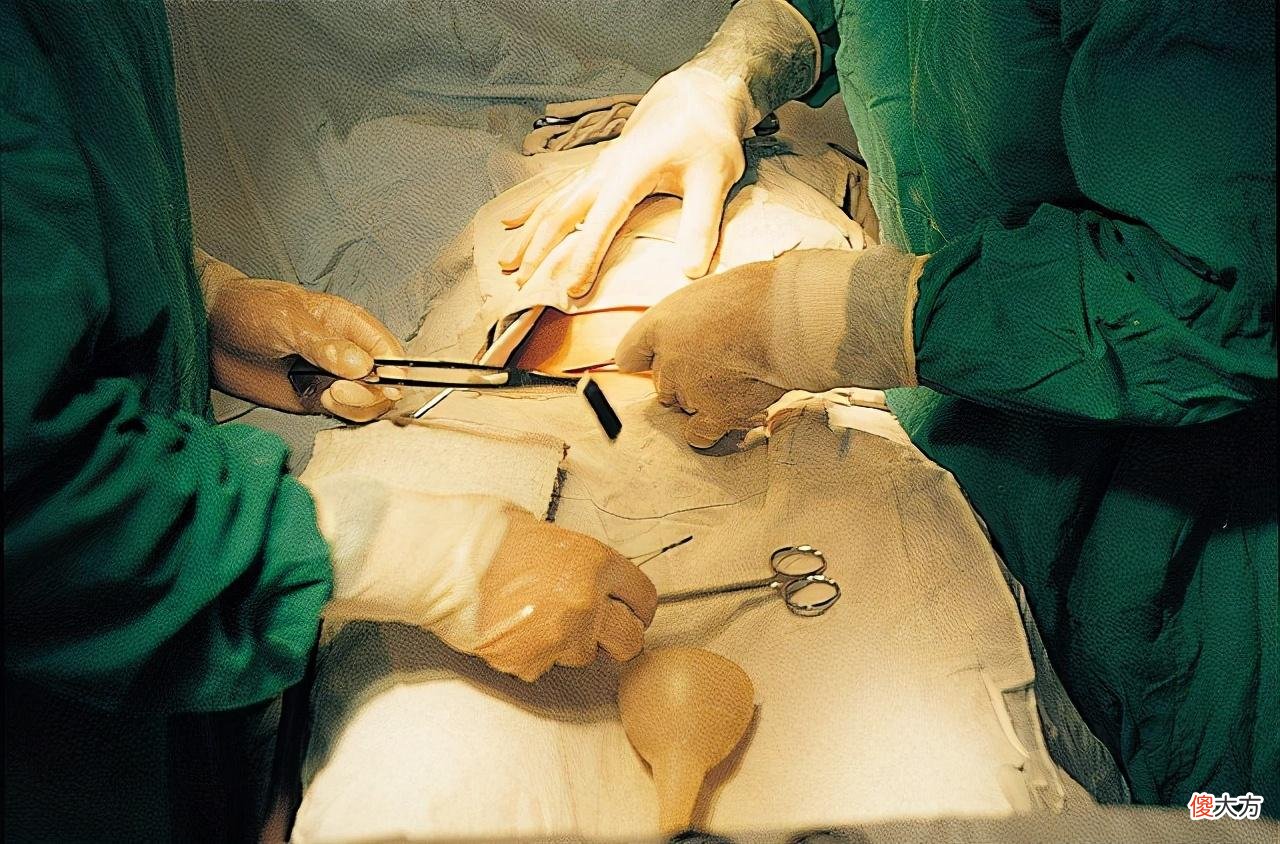 剖腹产选择“横切”还是“竖切”？别轻视这一刀，两者效果大不同