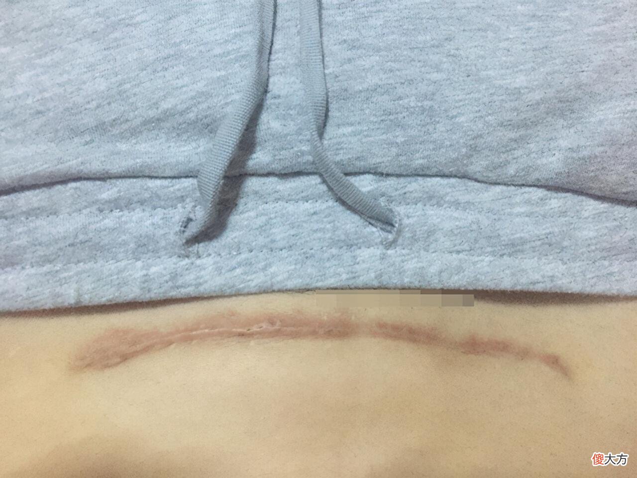 剖腹产选择“横切”还是“竖切”？别轻视这一刀，两者效果大不同