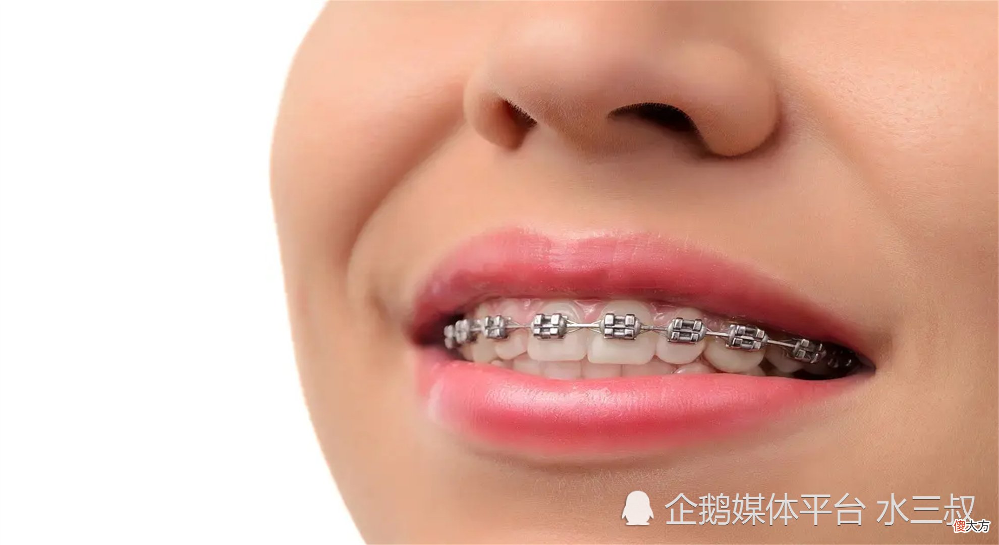 孩子戴牙套要注意什么？原来我们忽略了这3点，现在知道还来得及