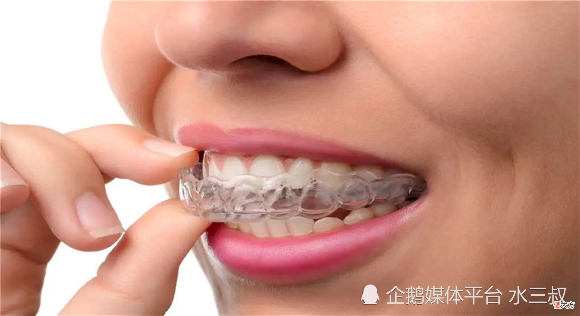 孩子戴牙套要注意什么？原来我们忽略了这3点，现在知道还来得及