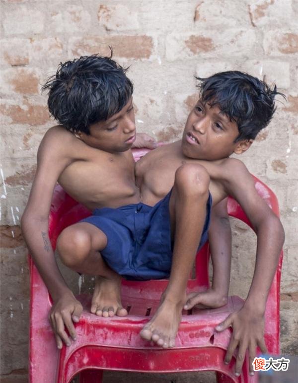 印度双胞胎兄弟共用一双腿和一个胃,拒绝接受分离手术