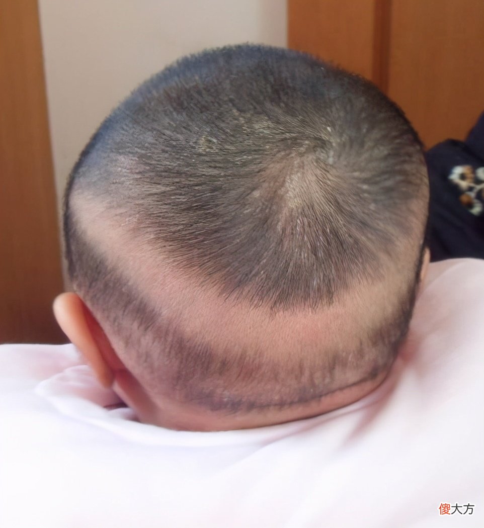 宝宝少一圈头发未必是缺钙，枕秃的原因有很多，宝妈可别盲目补钙
