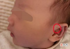 宝宝耳朵上的孔是“聪明孔”？家长别傻了，这可不是什么好兆头