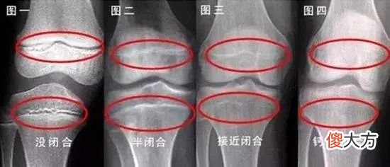 骨垢线闭合有感知？孩子出现3种变化，赶上“末班车”再长10厘米