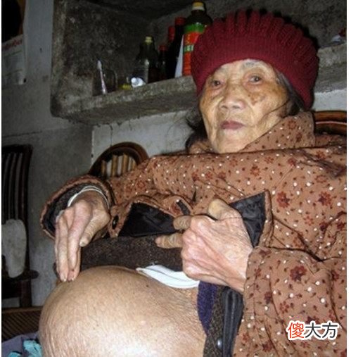 奇闻！92岁老太身怀死胎58年