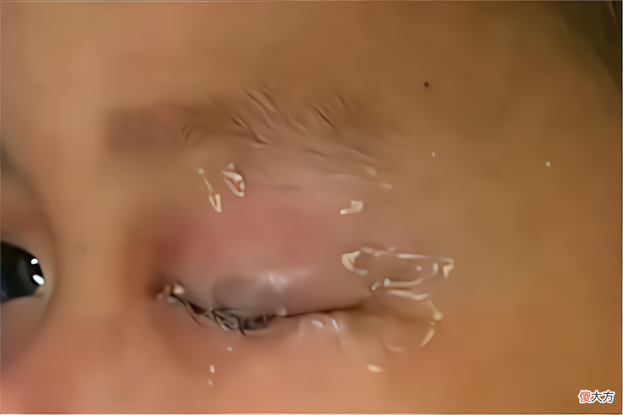 502胶水进入眼睛如何处理伤害最小？虽然不常发生，家长需要了解