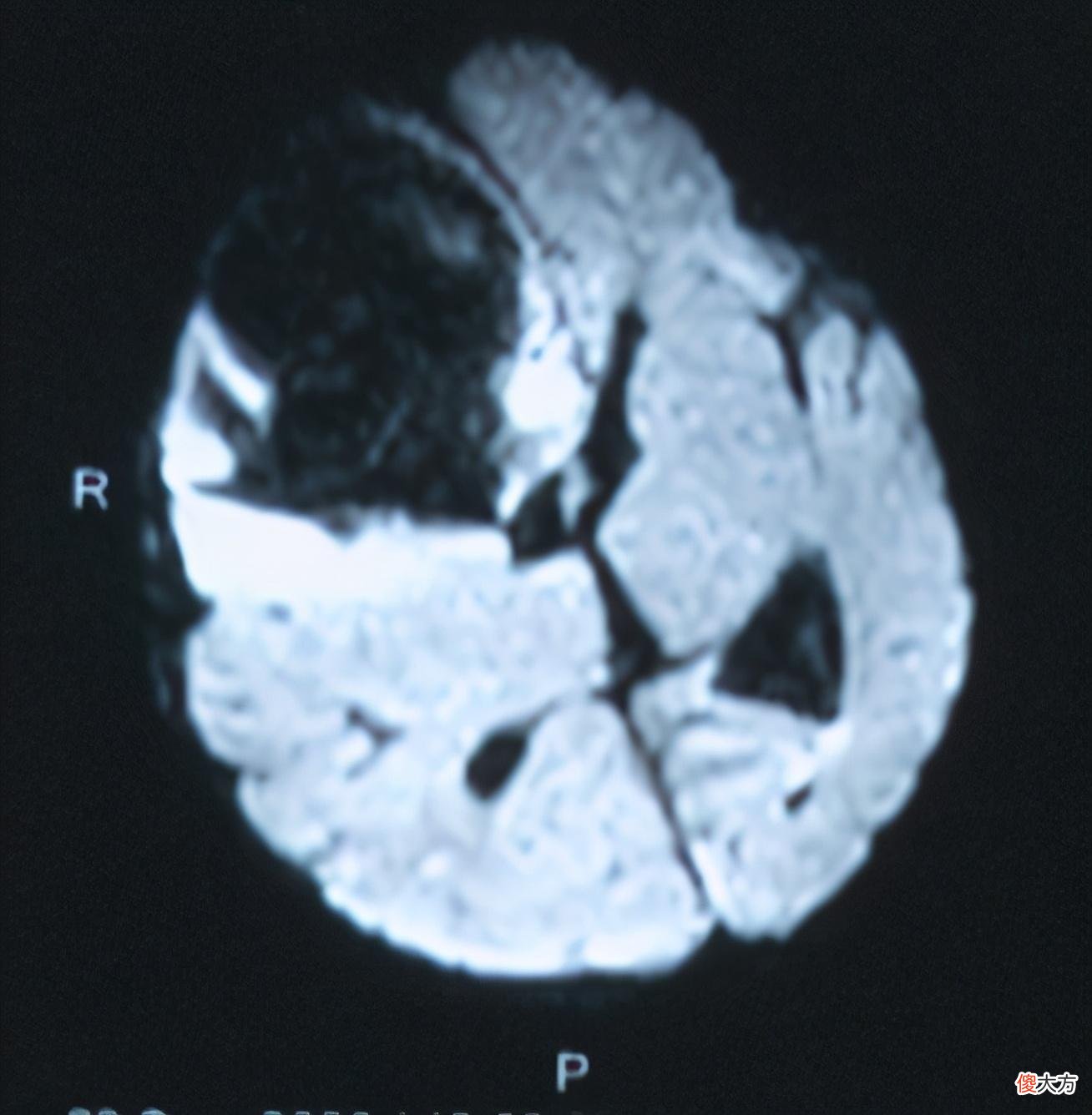 刚出生50天的孩子就有脑出血？医生：妈妈孕期就应该开始食补