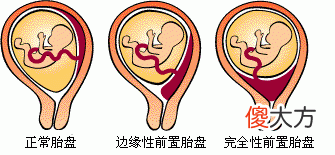 生孩子是去人民医院好，还是去妇幼保健院好呢？得看孕妇的情况定