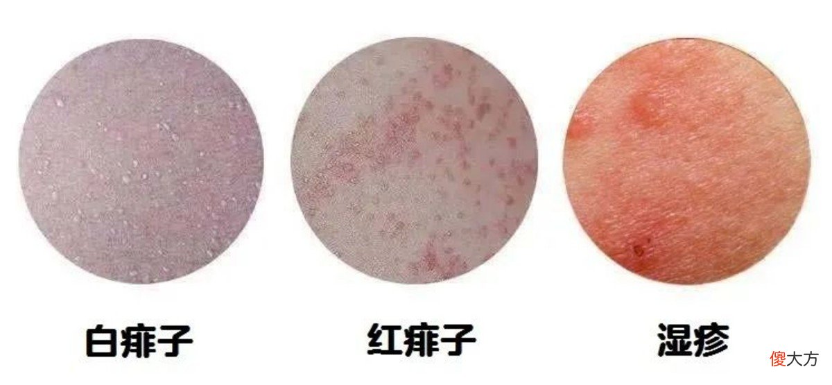 关于宝宝湿疹你知道多少？这份湿疹攻略，建议家长收藏备用