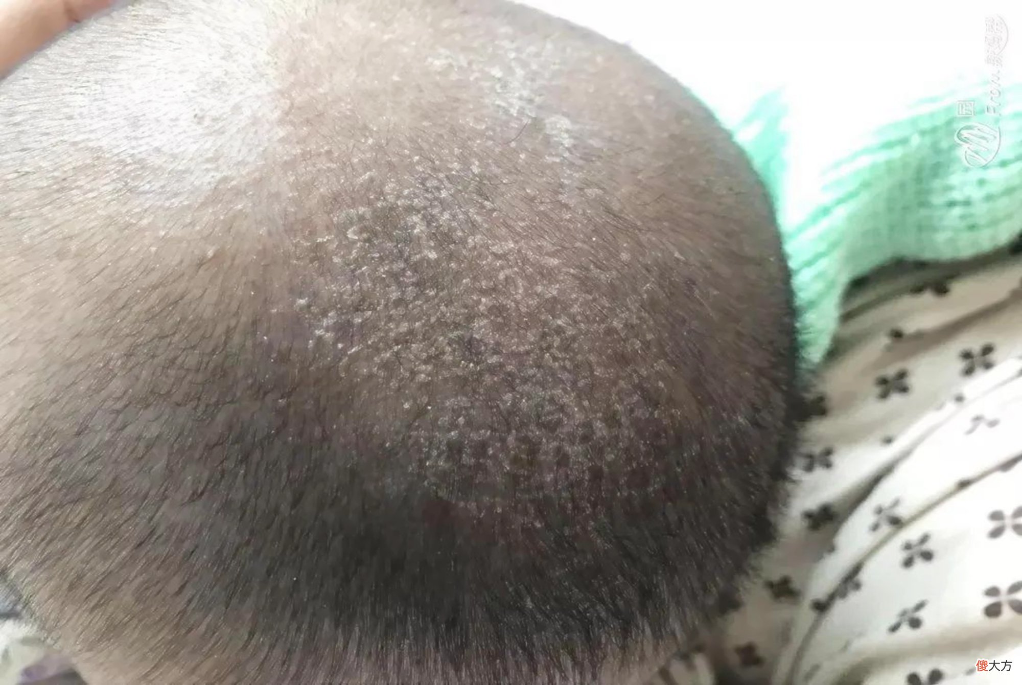新生儿头上的“白屑结痂”如何去除？四个方法可尝试，切勿冒进