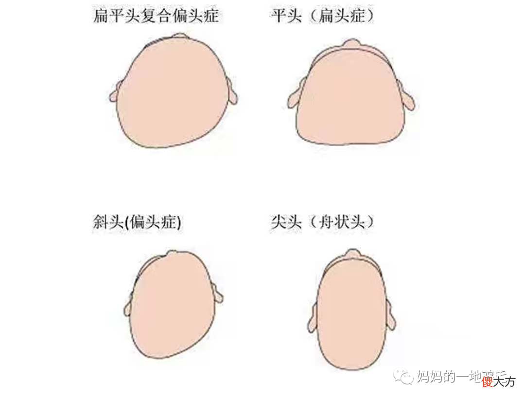 宝宝扁头影响大脑发育吗?