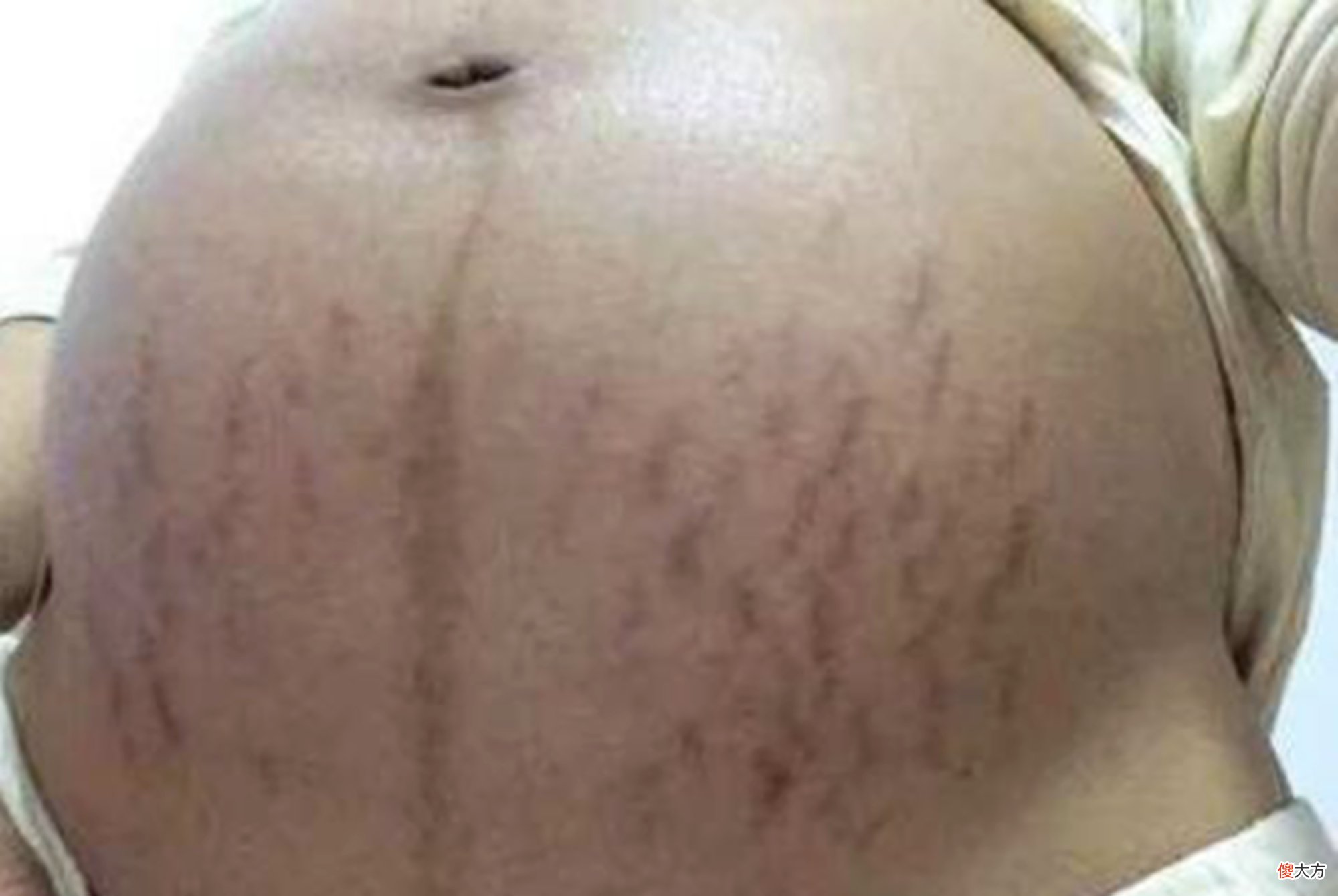 花一万二除妊娠纹的宝妈未见成效，面对顽固妊娠纹，要从预防抓起