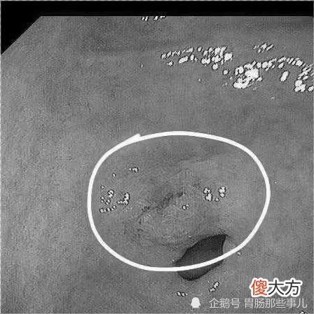 30岁孕妇，持续恶心呕吐，当成妊娠反应；产后20天，被确诊进展期胃癌！