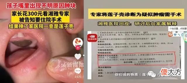 丢人现眼!湘雅医院把孩子嘴里莲子壳诊断为肿瘤,要求住院切除