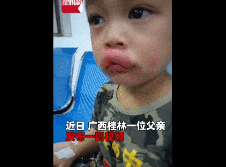 男孩吃葡萄后嘴肿成面包，媲美电影中香肠嘴，医生：不可掉以轻心