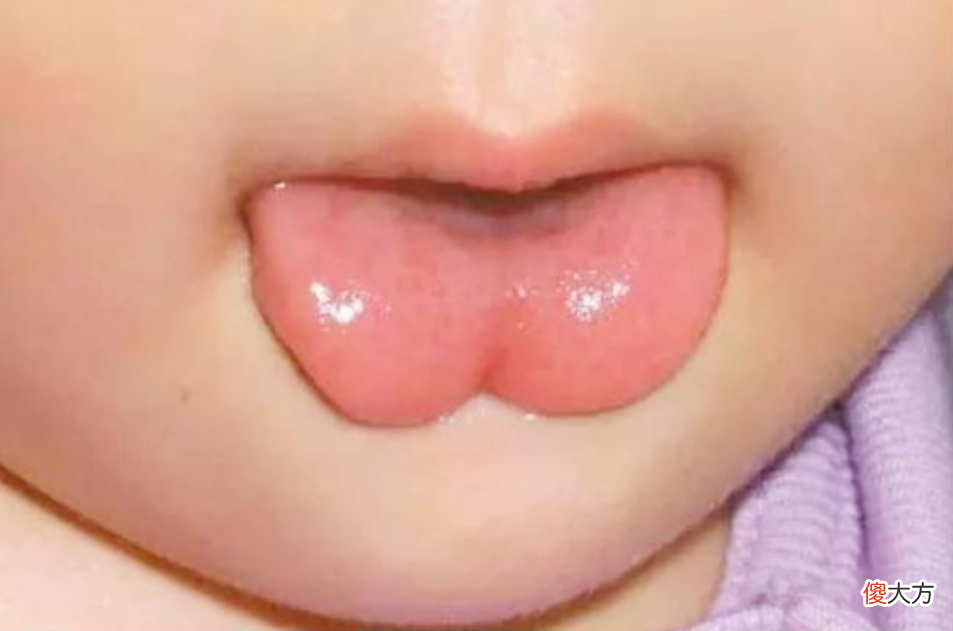 宝宝不剪“舌根”以后说话不利索？父母别信，很多孩子被害惨