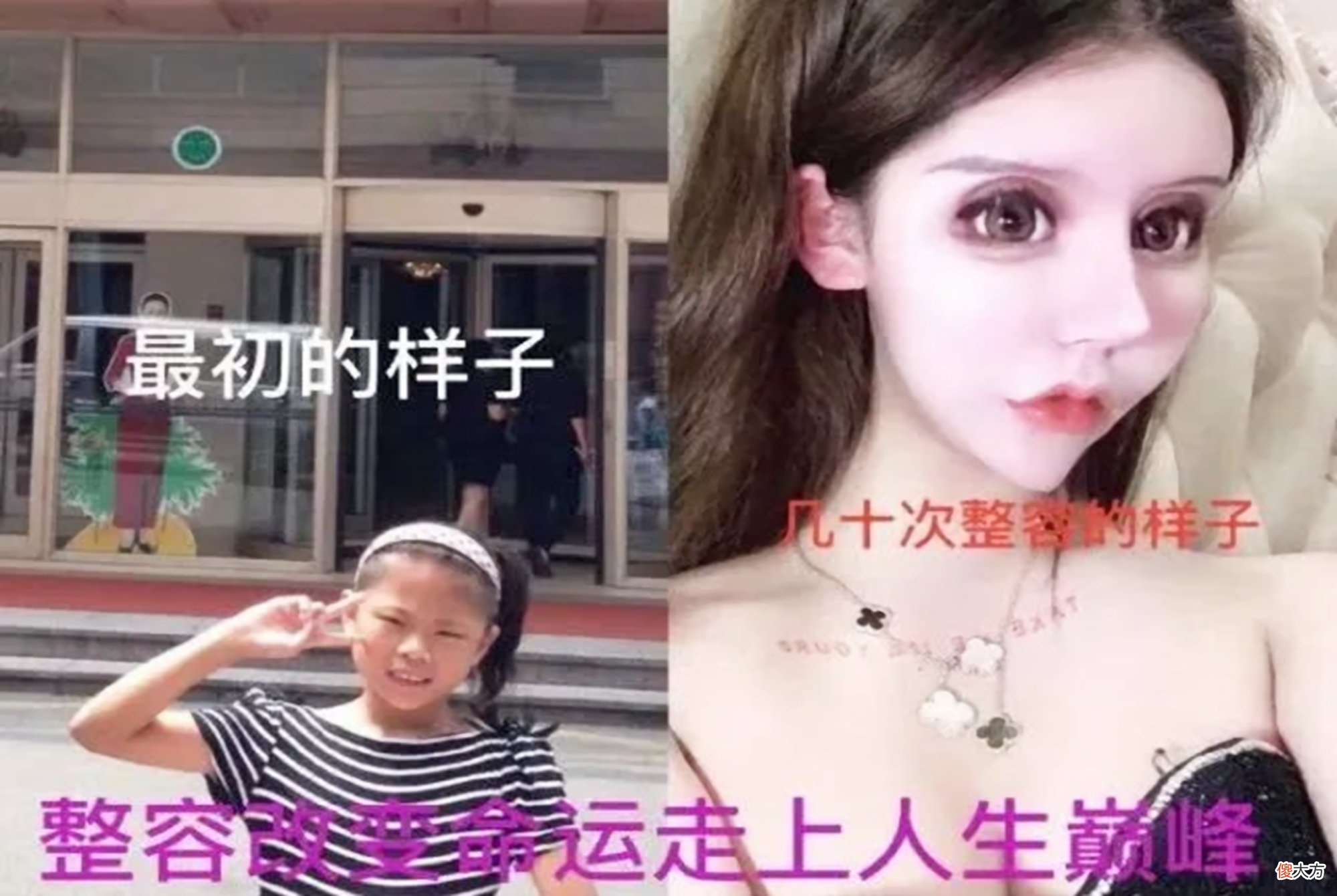 单眼皮女孩在消失？第一批00后成整容“主力军”，背后推手是父母